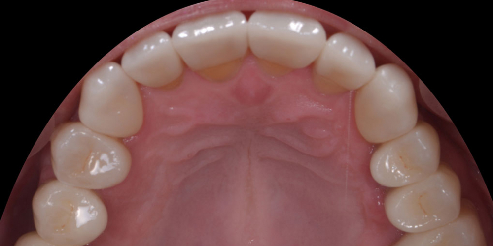 Тотальная стоматологическая реабилитация пациента: 6 дентальных имплантов, 28 керамических виниров - фото №5