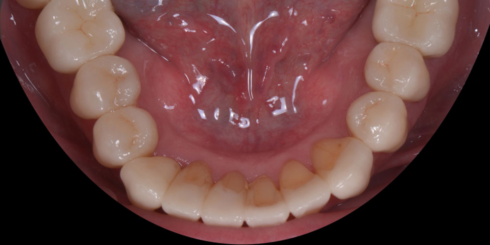 Тотальная стоматологическая реабилитация пациента: 6 дентальных имплантов, 28 керамических виниров - фото №6