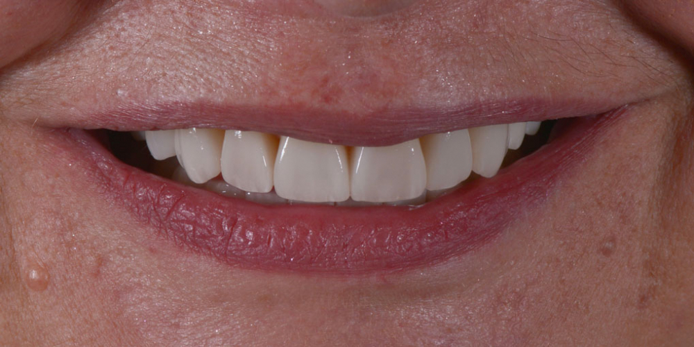 Тотальная стоматологическая реабилитация пациента: 6 дентальных имплантов, 28 керамических виниров - фото №2
