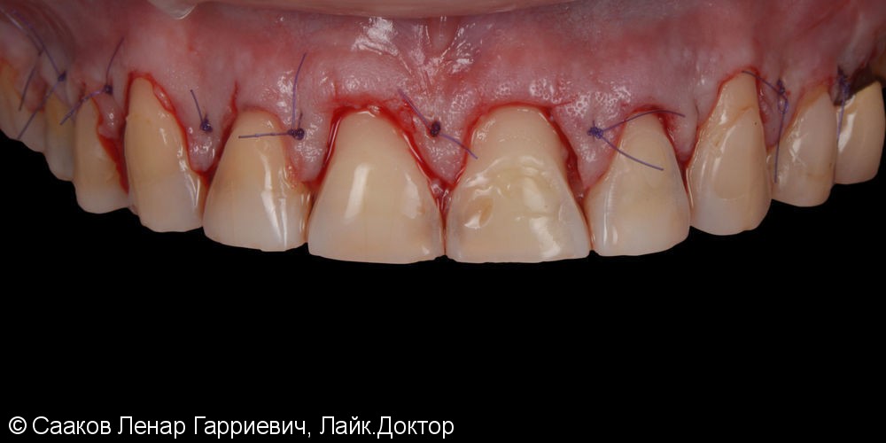 Эстетическая реабилитация с помощью керамических виниров и имплантатов - фото №4