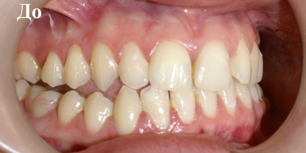 Исправление положения челюстей и неправильного положения зубов - фото №3