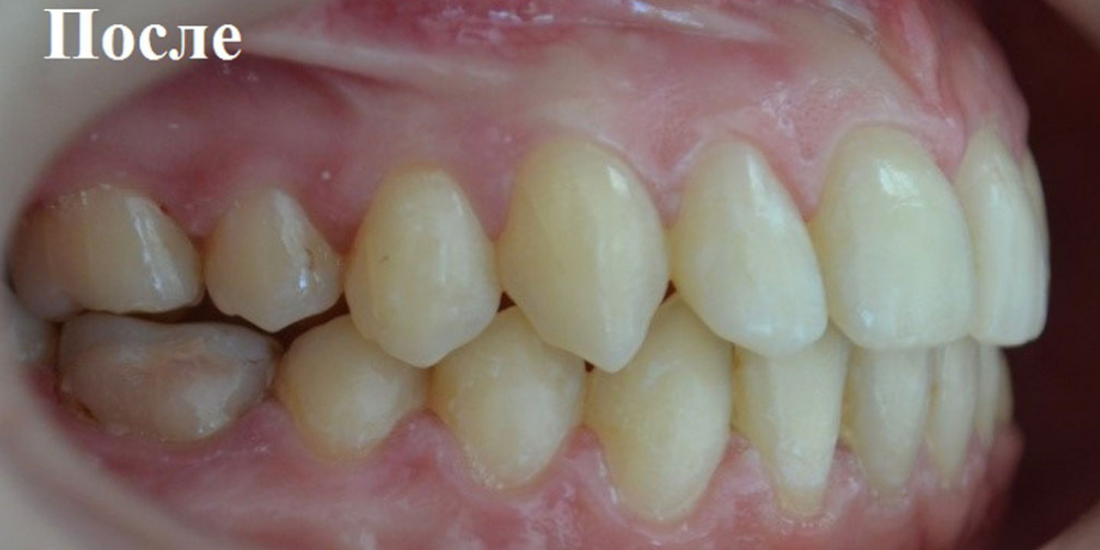 Исправление положения челюстей и неправильного положения зубов - фото №2