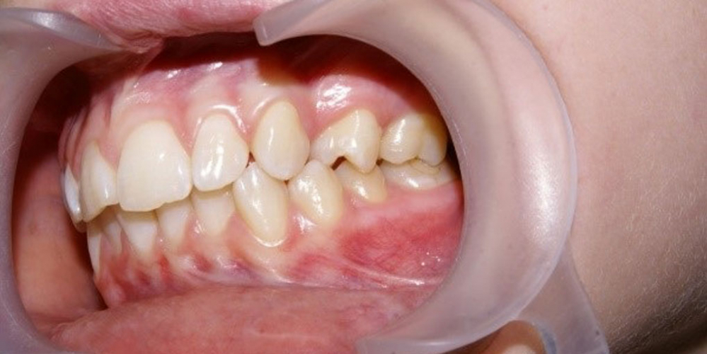 Результат выравнивания зубов на нижней и верхней челюстях - фото №3