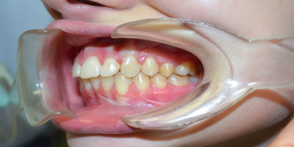 Результат выравнивания зубов на нижней и верхней челюстях - фото №7