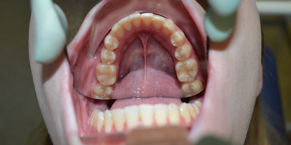 Результат выравнивания зубов на нижней и верхней челюстях - фото №8