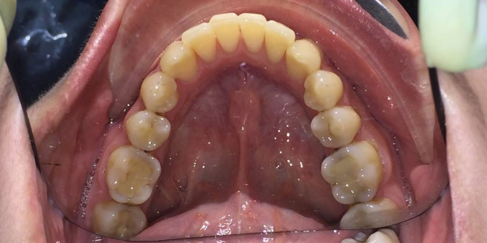 Результат исправления кривых зубов с помощью брекетов - фото №4