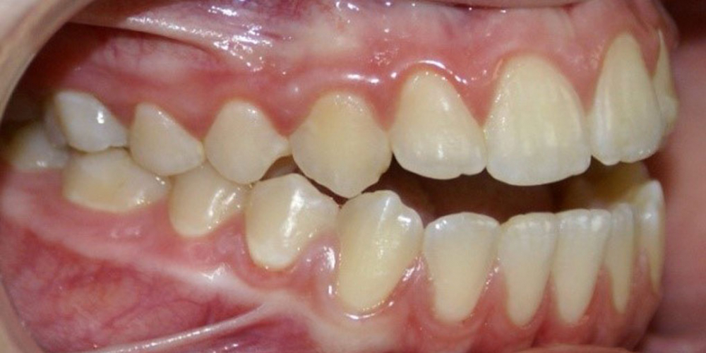 Результат исправления неровности зубов на верхней и нижней челюстях - фото №3