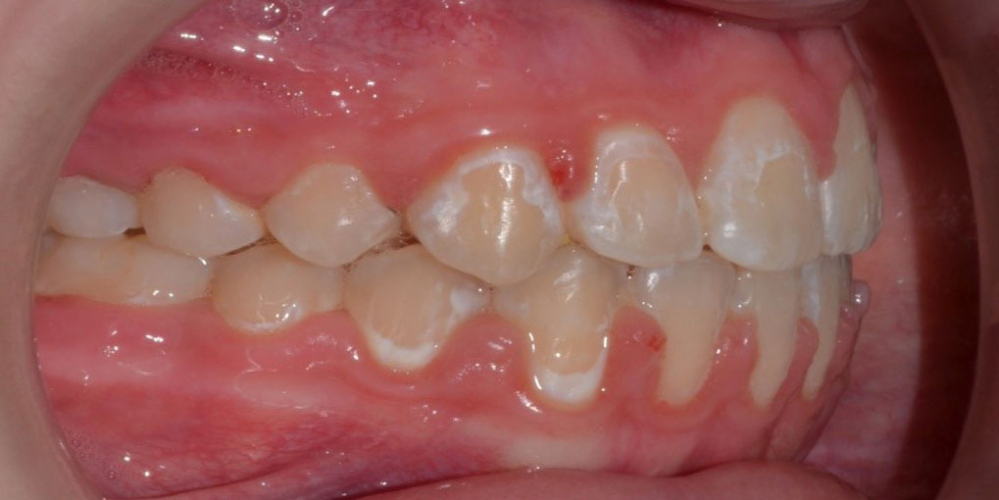 Результат исправления неровности зубов на верхней и нижней челюстях - фото №2