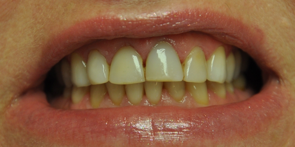 Пигментированные реставрации на зубах фронтальной группы - фото №1