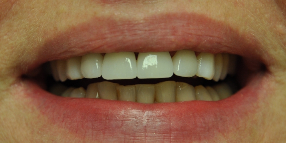 Пигментированные реставрации на зубах фронтальной группы - фото №2