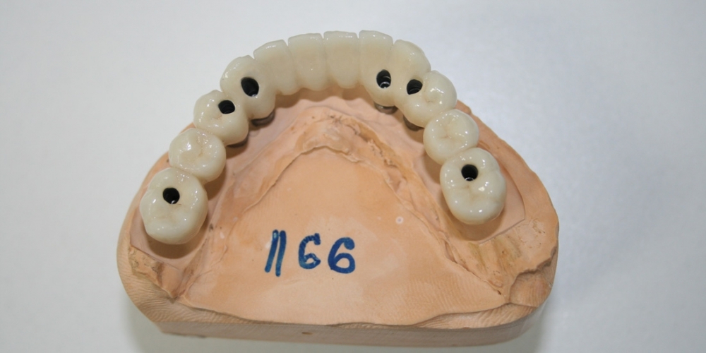 Полное протезирование мостовидными протезами с винтовой фиксацией на имплантатах Dentium - фото №1