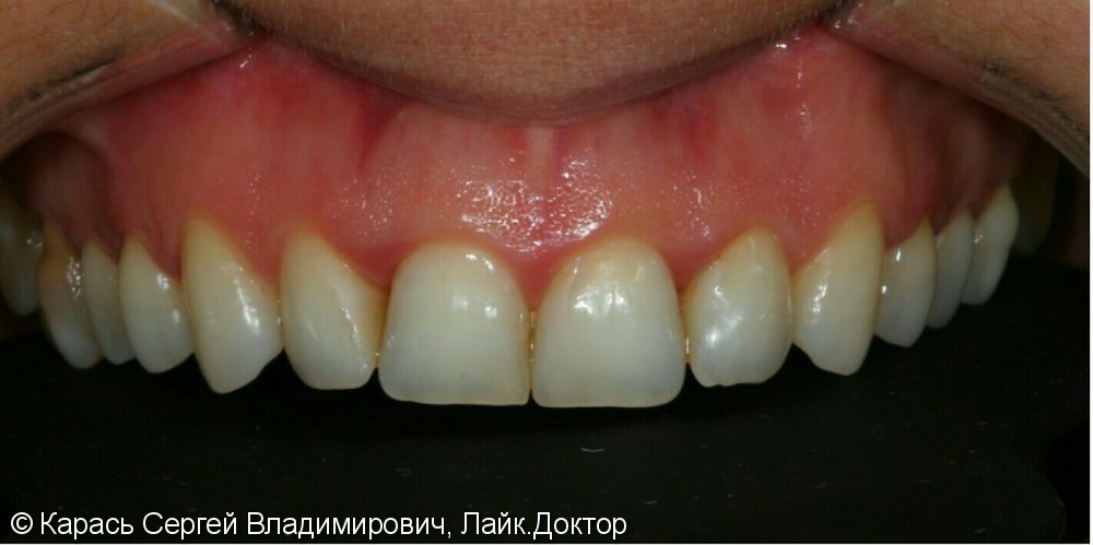 Реставрация 13 ти зубов на верхней челюсти - фото №1