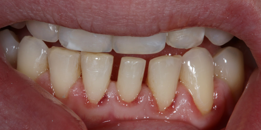 Терапевтический винир, микродентия зуба - фото №1