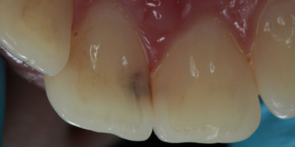 Лечение кариеса на фронтальных зубах с  использованием дентального микроскопа - фото №1