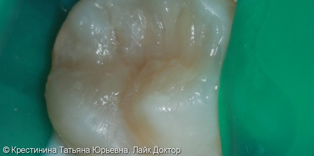 Лечение коренного зуба под микроскопом - фото №3