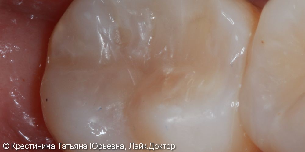 Лечение коренного зуба под микроскопом - фото №5