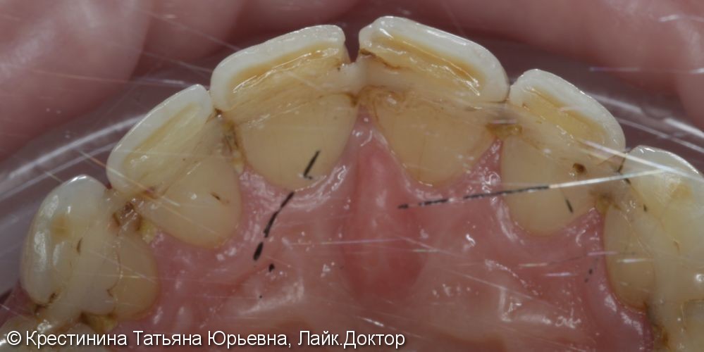 Лечение кариеса передних зубов, до и после - фото №2