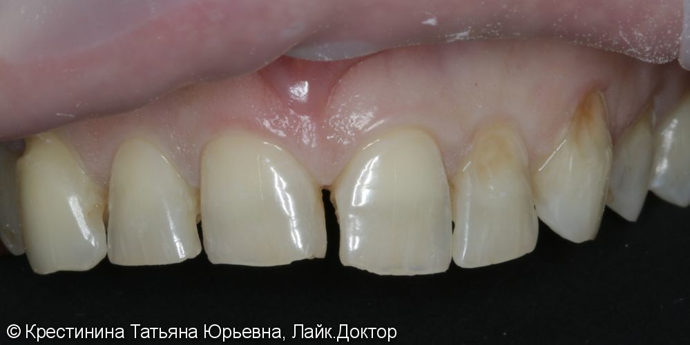 Лечение кариеса передних зубов, до и после - фото №3