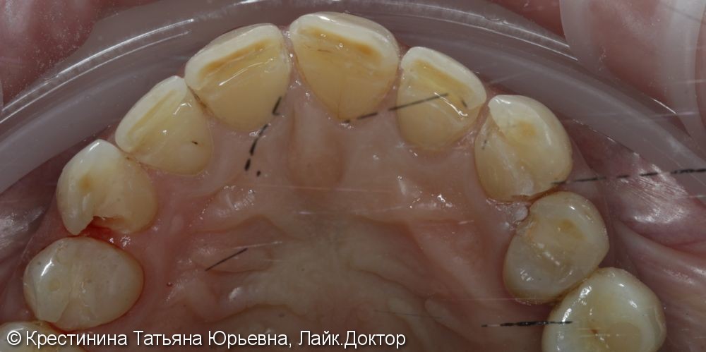 Лечение кариеса передних зубов, до и после - фото №4