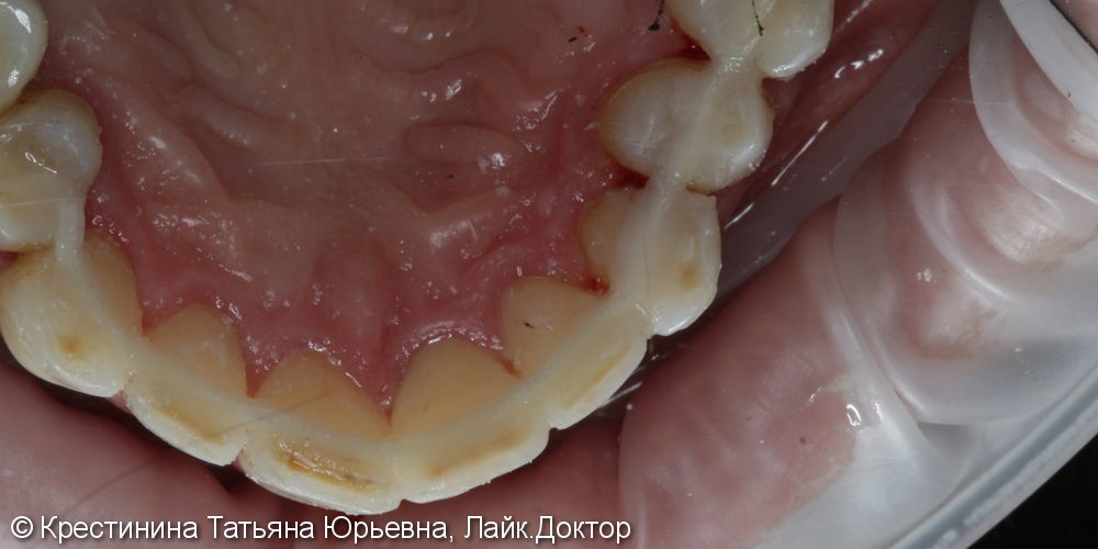 Лечение кариеса передних зубов, до и после - фото №5