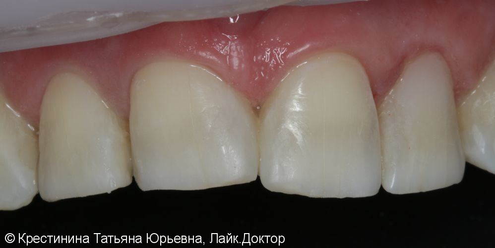 Лечение кариеса передних зубов, до и после - фото №6