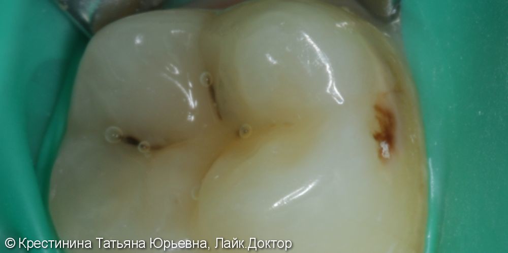 Лечение кариеса коренного зуба - фото №1