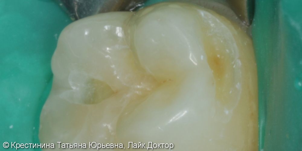 Лечение кариеса коренного зуба - фото №2