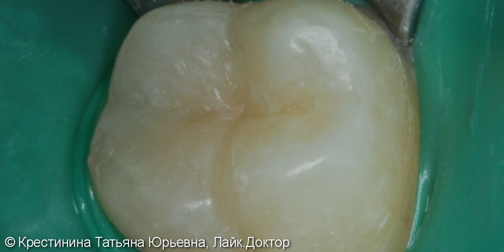 Лечение кариеса коренного зуба - фото №3