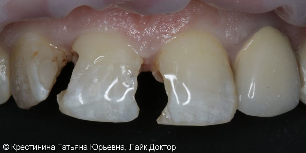 Лечение кариеса и  реставрация передних зубов - фото №2
