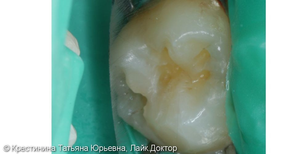 Лечение кариеса зуба - фото №2