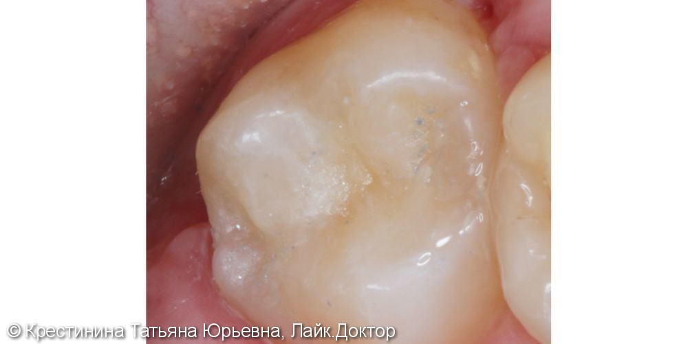 Лечение кариеса зуба - фото №4