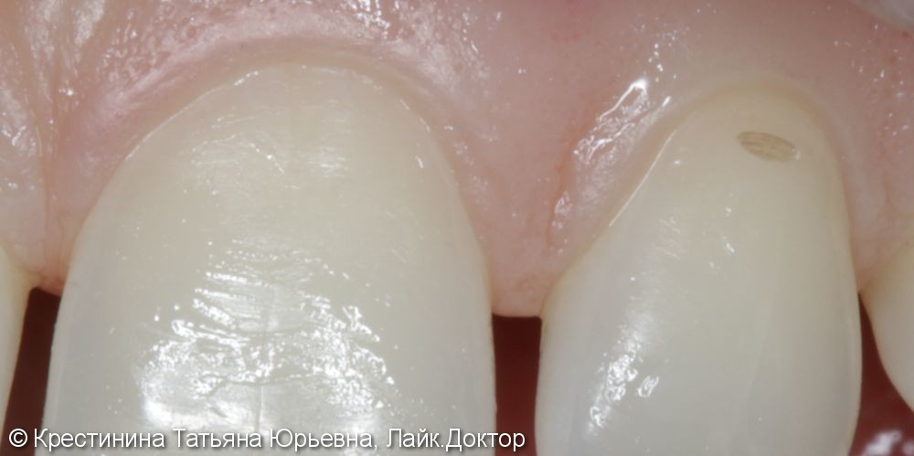 Лечение клиновидного дефекта зубов - фото №1