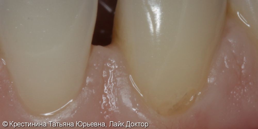 Лечение клиновидного дефекта зубов - фото №2
