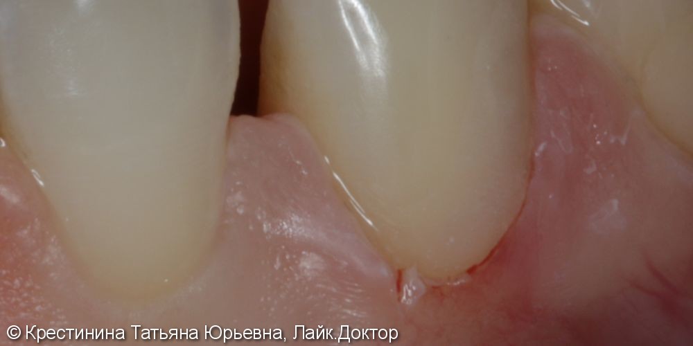Лечение клиновидного дефекта зубов - фото №3