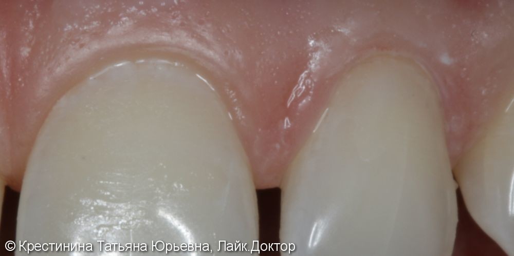Лечение клиновидного дефекта зубов - фото №4