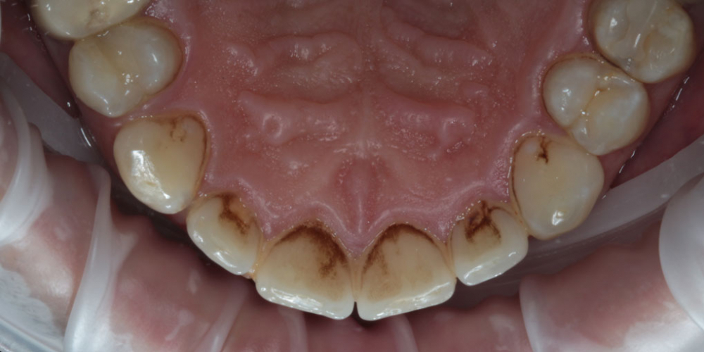 Результат профессиональной чистки зубов от темного налета, жалобы на неприятный запах - фото №1