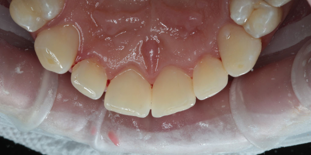 Результат профессиональной чистки зубов от темного налета, жалобы на неприятный запах - фото №2