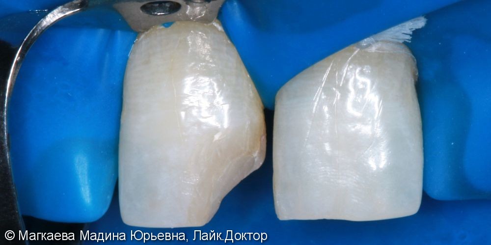 Реставрация зубов композитом - фото №2