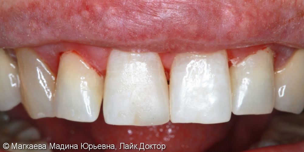 Реставрация зубов композитом - фото №3