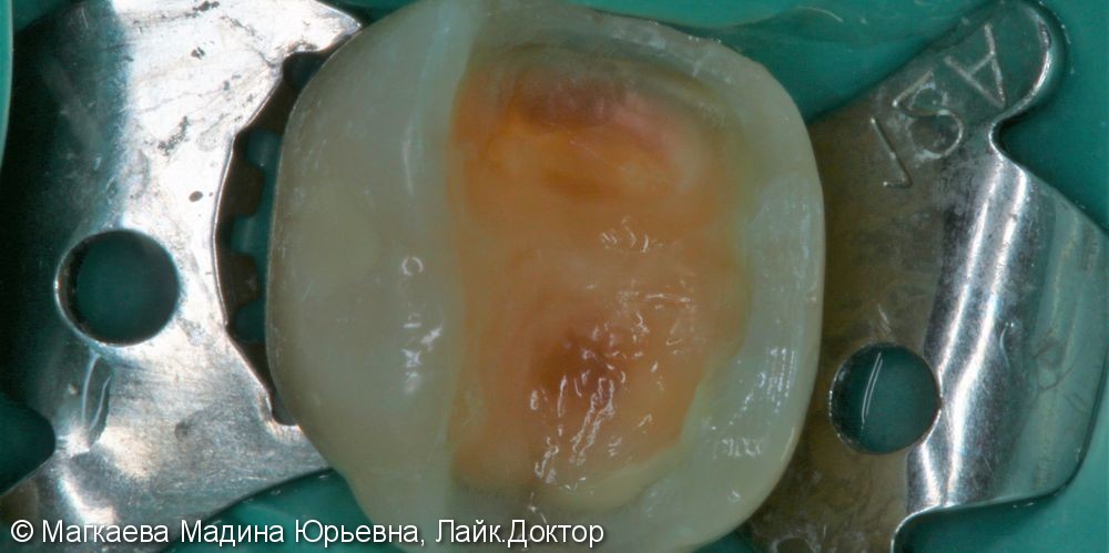Лечение кариеса коренного зуба под микроскопом - фото №2