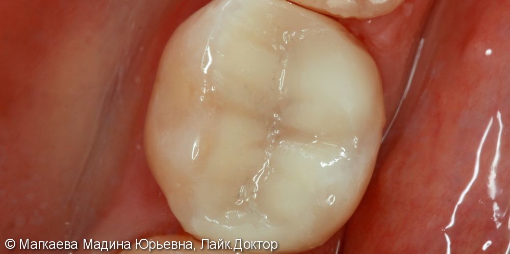Лечение кариеса коренного зуба под микроскопом - фото №4