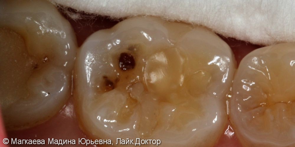 Лечение кариеса коренного зуба, до и после - фото №1