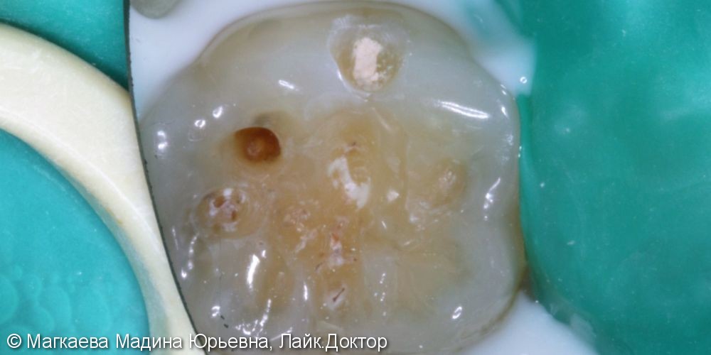 Лечение кариеса коренного зуба, до и после - фото №2