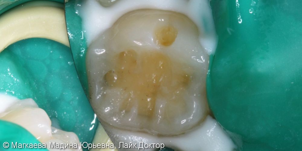 Лечение кариеса коренного зуба, до и после - фото №3