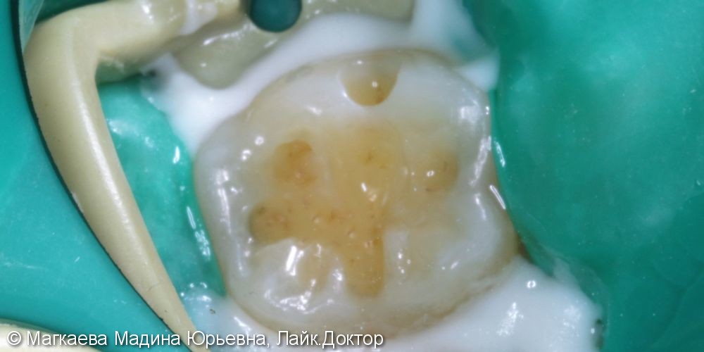 Лечение кариеса коренного зуба, до и после - фото №4