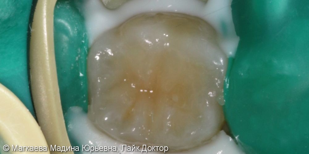 Лечение кариеса коренного зуба, до и после - фото №5