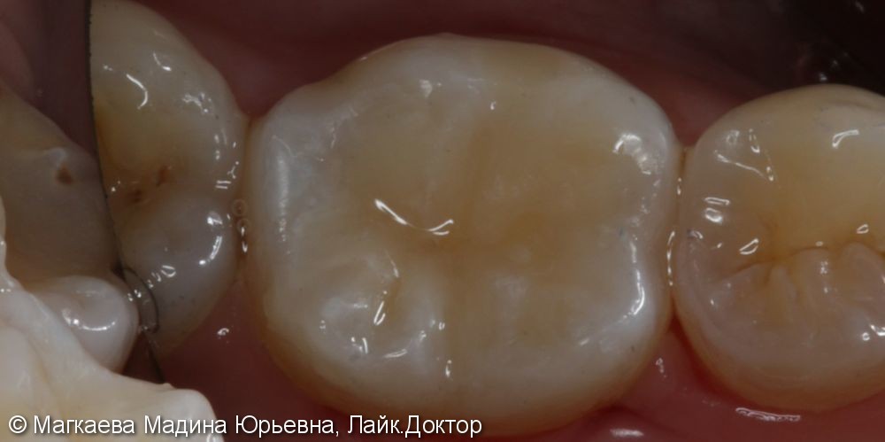 Лечение кариеса коренного зуба, до и после - фото №6