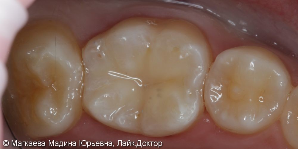 Лечение кариеса коренного зуба под микроскопом - фото №3