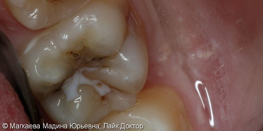 Лечение кариеса коренного зуба под микроскопом - фото №1