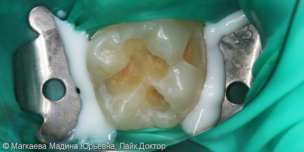 Лечение кариеса коренного зуба под микроскопом - фото №3